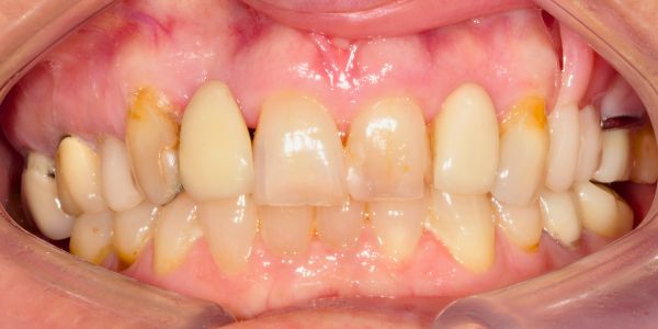 Case 2 Bridges & Veneers Before