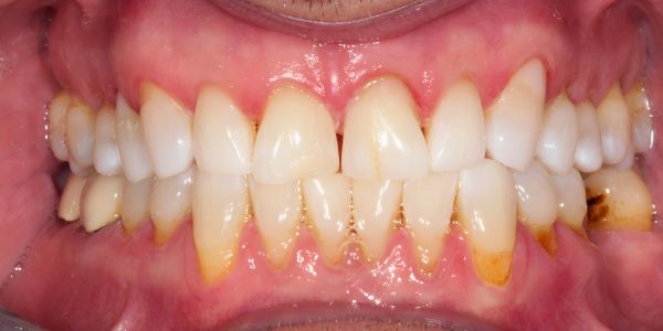 Case 4 Whitening After