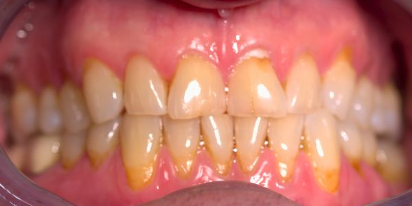 Case 4 Whitening Before