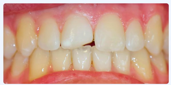 Case 5 Composite Filling Before