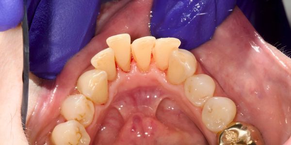 Case 6 Airflow after