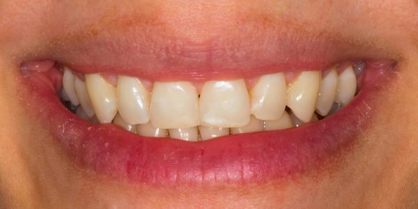 Case 7 Composite filling After